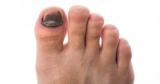 Vì sao móng chân bị đen khi chạy và cách chữa