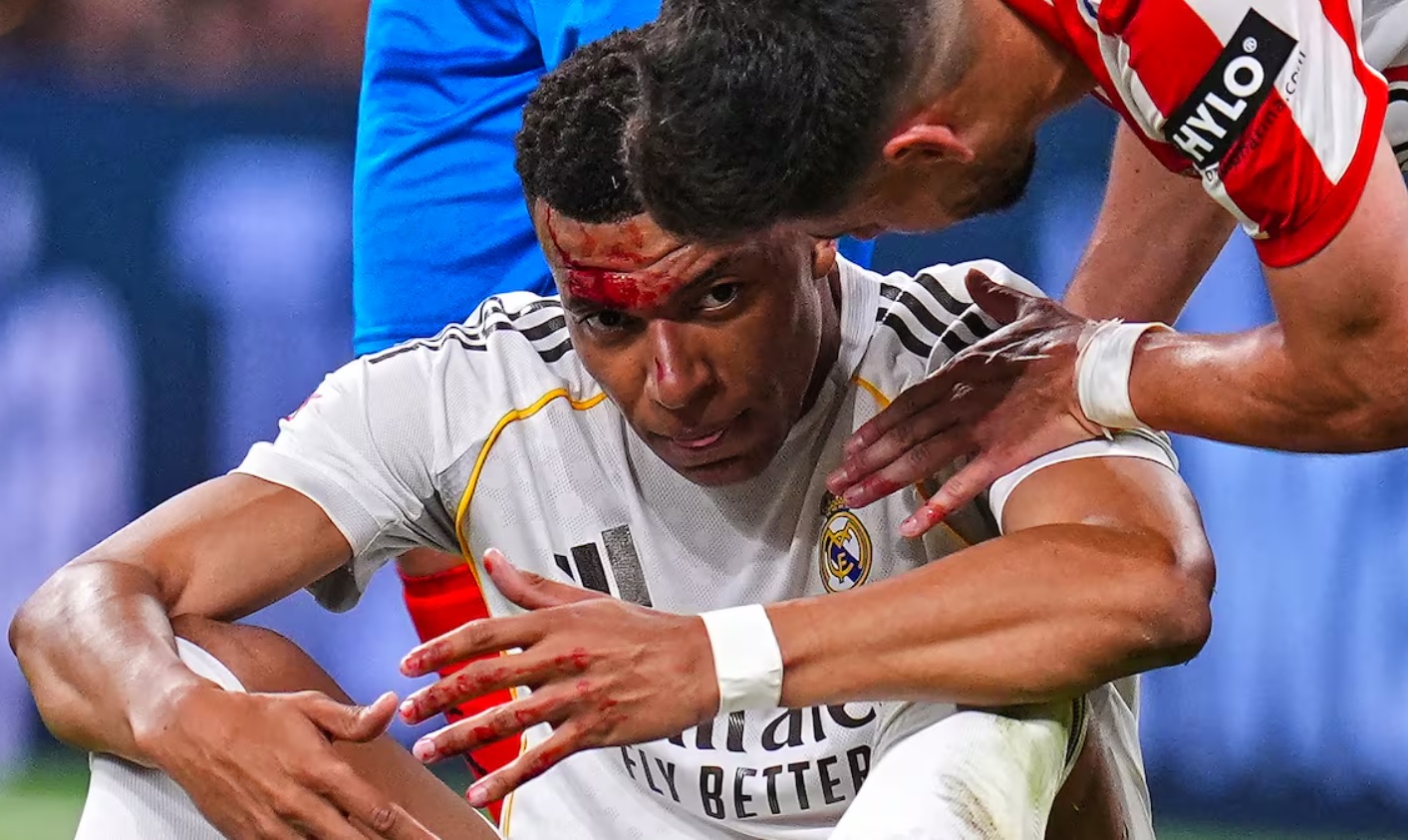 Mbappe đổ máu sau pha phạm lỗi dẫn đến quả phạt đền không được thổi phạt