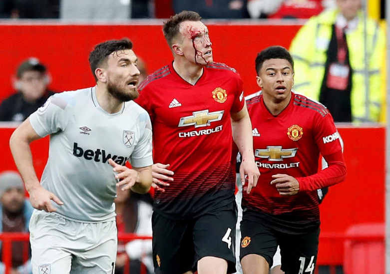 Cận cảnh chấn thương rợn người của Phil Jones ở trận gặp West Ham