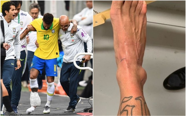 Neymar tung ảnh mắt cá chân sưng to... "kinh dị" sau khi bị loại khỏi Copa America 2019