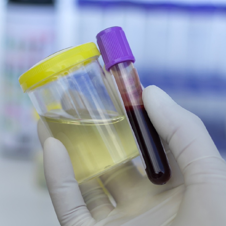 Các võ sĩ UFC xét nghiệm Doping như thế nào?