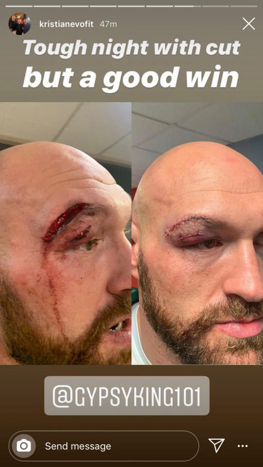 Tyson Fury khâu 50 mũi sau trận đấu với Otto Wallin Tyson Fury khâu 50 mũi sau trận đấu với Otto Wallin