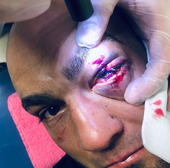 Eddie Alvarez suýt bị xé mất mí mắt tại A New Era Eddie Alvarez suýt bị xé mất mí mắt tại A New Era