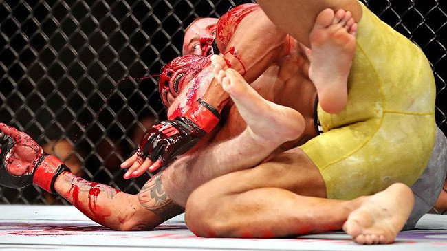 Alex Oliveira khâu 29 mũi trên đầu sau khi "ăn" cùi chỏ của Gunnar Nelson