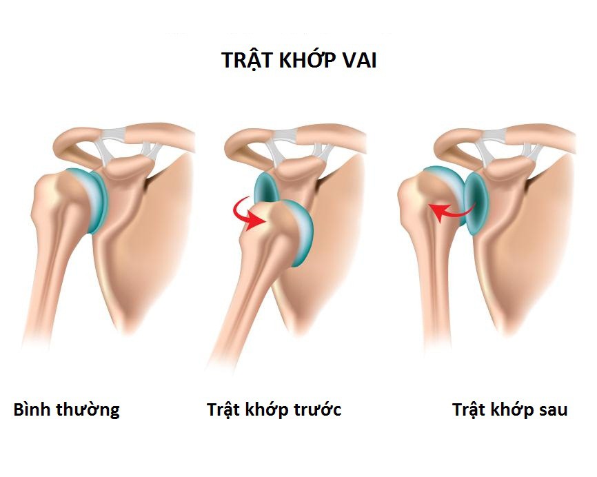 Trật khớp