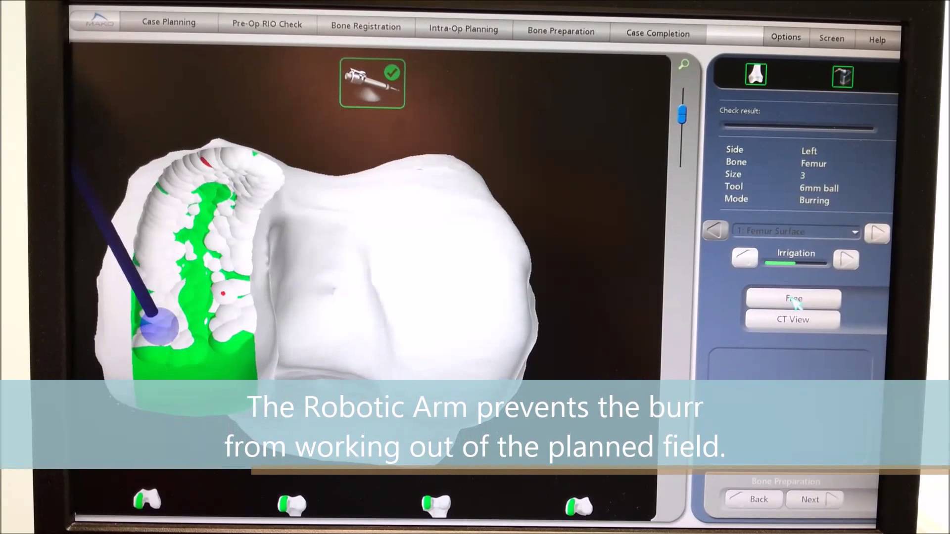 Bác sỹ Jeffrey Chew: Chuyên gia phẫu thuật đầu gối bằng robot