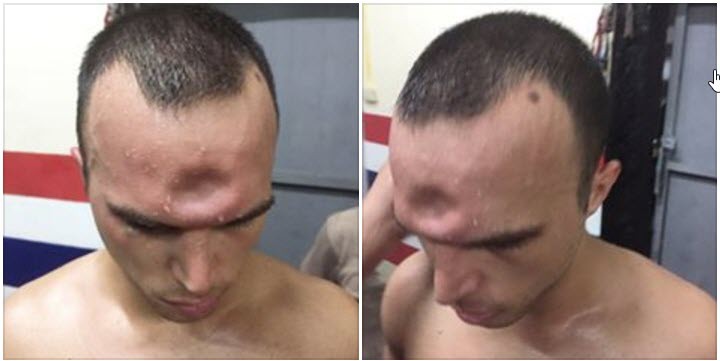 Bản tin MMA 15/12: Võ sĩ Muay Thái dính chỏ, móp xương trán