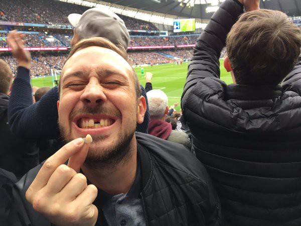 Fan mất răng vì chiến thắng của Man Utd