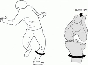 C&oacute; khoảng 70% tổn thương d&acirc;y chằng ch&eacute;o trước do nguy&ecirc;n nh&acirc;n chấn thương gi&aacute;n tiếp, trong khi khoảng 30% do chấn thương trực tiếp. Nguồn: Bệnh viện Đa Khoa Vạn Hạnh
