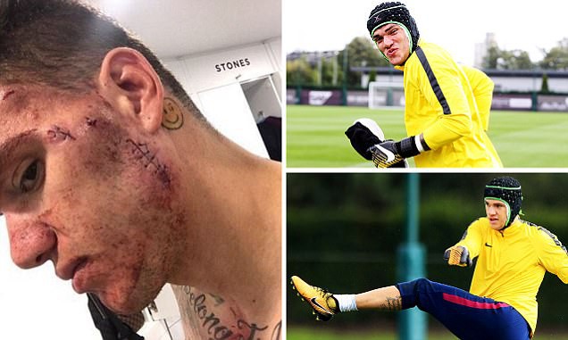 Ederson với gương mặt kh&acirc;u v&aacute; chằng chịt