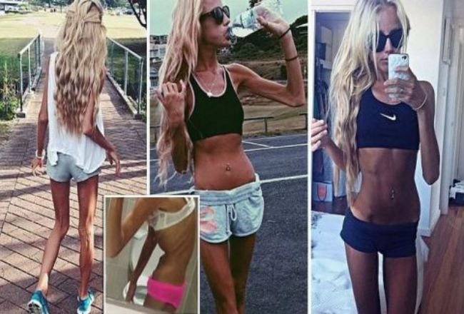 Suýt chết vì nhịn ăn, bắt chước Siêu mẫu